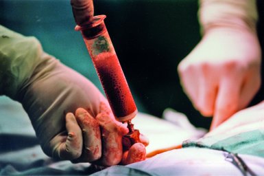 Hlavní obrázek - Studie MESEMS: u transplantace kmenových buněk při RS se zatím prokázala jen bezpečnost